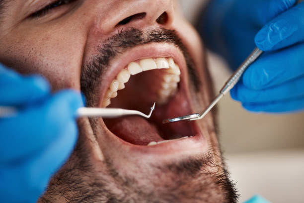 Best Emergency Treatment for Dental Infections or Abscesses in Golden Grove, SC